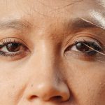 Blépharoplastie