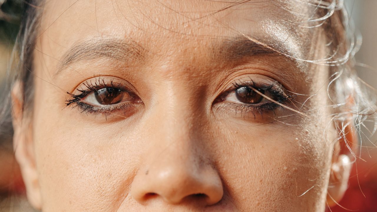 Blépharoplastie